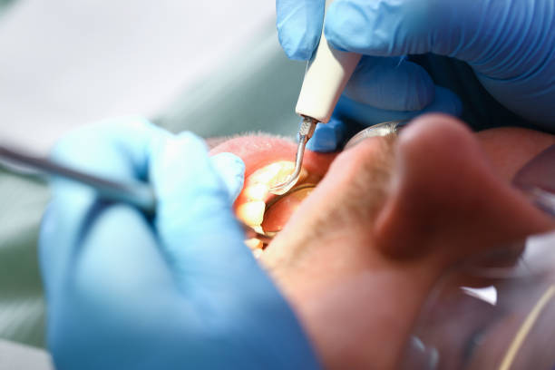 Best Chipped Tooth Repair Near Me  in Beaver, UT